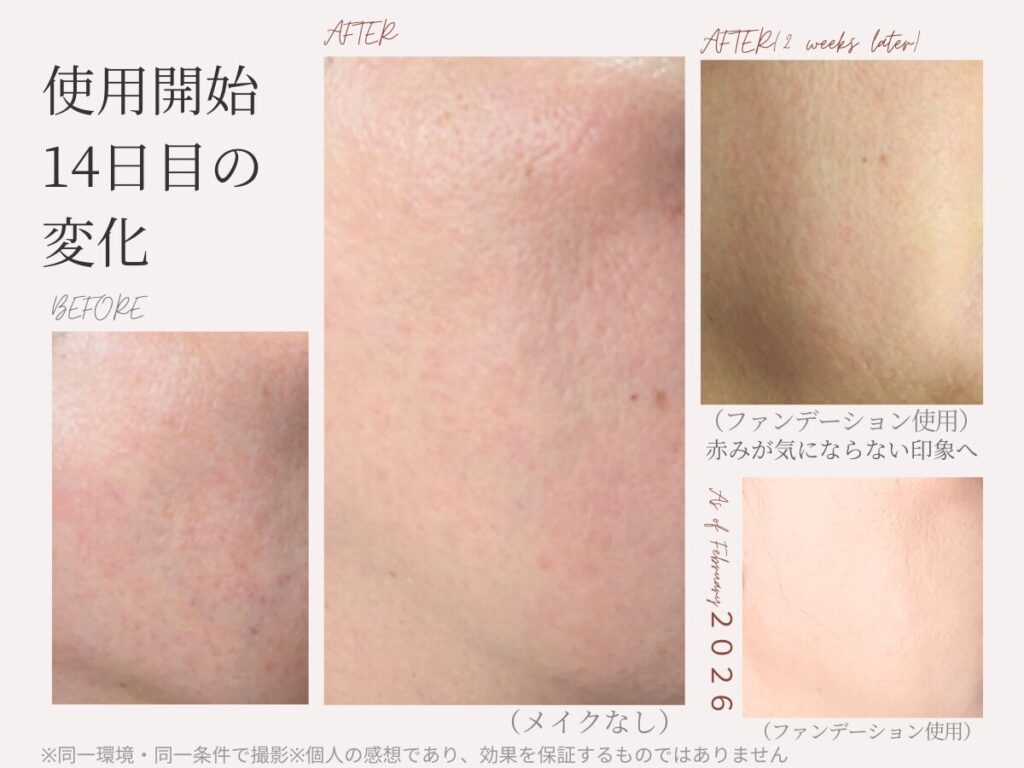 DoMeCareアゼレストクリームを14日間使用した顔の赤みのビフォーアフター比較写真